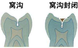 儿童窝沟封闭的时期
