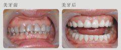 瓷贴面修复牙齿的价格是多少？