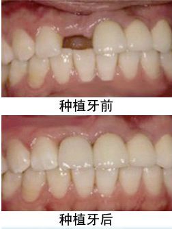 在洛阳补一颗国产种植牙一般是多少钱？
