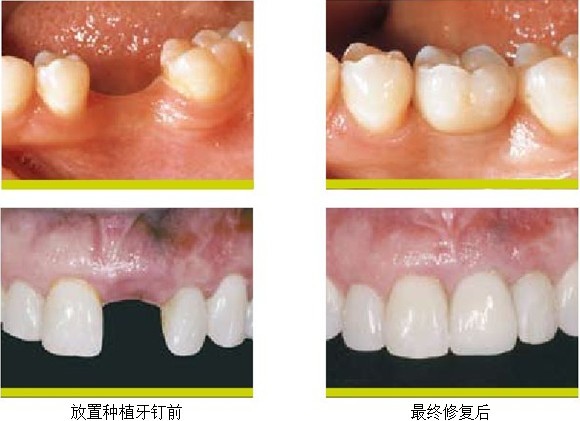 全口种植一般要多少钱？