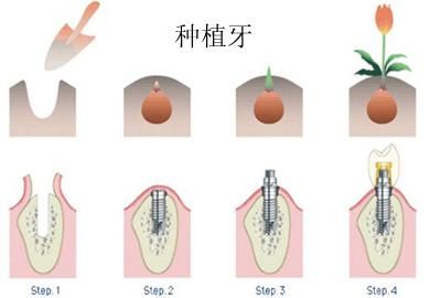 全口牙缺失，一起种牙要多少钱？