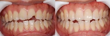 烤瓷牙有哪几种材料？