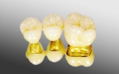 烤瓷牙的危害