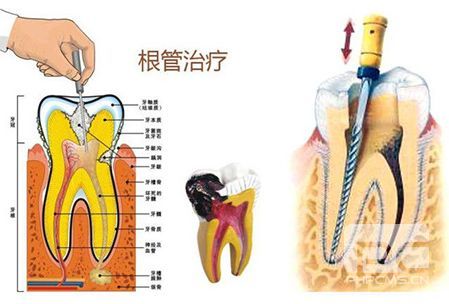 根管治疗方法及过程