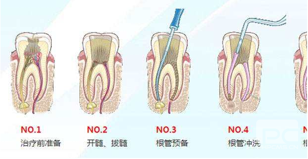根管治疗多少钱？