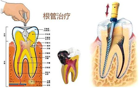 什么是根管治疗？