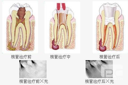 维乐口腔做根管治疗效果好不好？