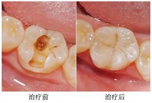 牙齿蛀牙怎么补？
