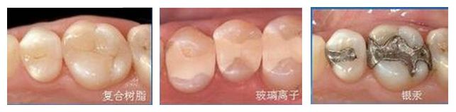 补牙什么材料好？