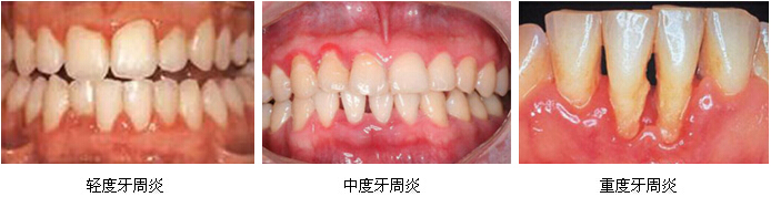 治疗牙周炎要多少钱？