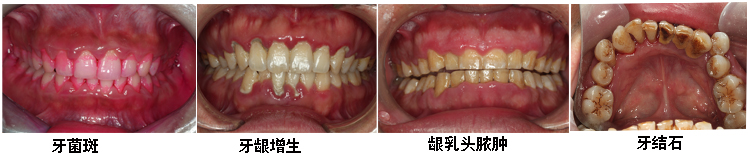 牙龈炎治疗多少钱？