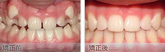 洛阳维乐口腔牙齿矫正材料