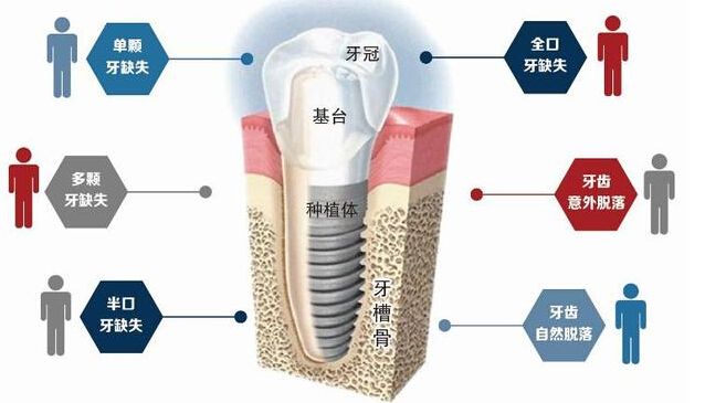单颗/多颗牙缺失，美学种植牙让你长新牙