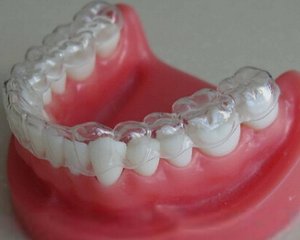 牙齿隐形矫正需要多久时间？