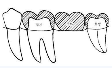 镶牙是活动假牙好还是固定假牙好？