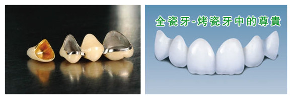 烤瓷牙与美容冠的区别？