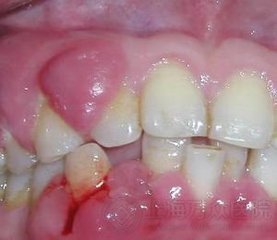 洛阳牙龈肿痛出血治疗需要多少钱？