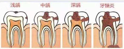洛阳治疗牙髓炎哪家医院好？