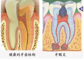 洛阳治疗牙髓炎多少钱？