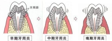 洛阳维乐口腔治疗牙周炎需要多少钱？