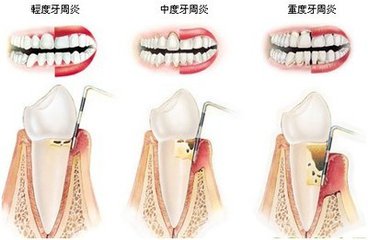 你知道预防牙周炎的方法有哪些吗？