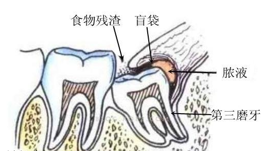 智齿一定要拔掉吗？