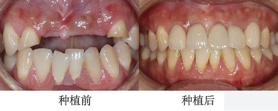 什么是种植牙
