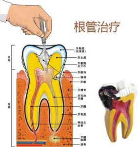 根管治疗方法及过程