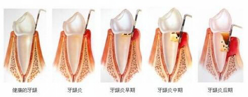 洛阳地区成人牙髓炎怎么治疗好？