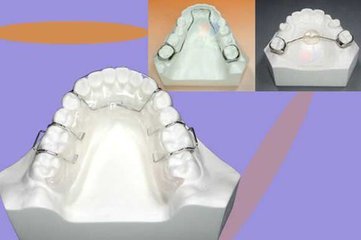 保持器多少钱？