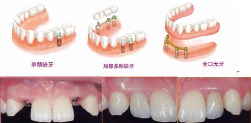 牙齿掉了怎么办？
