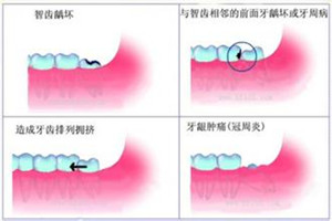 智齿一定要拔吗？