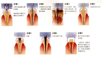 进行根管治疗选用什么填充材料好？