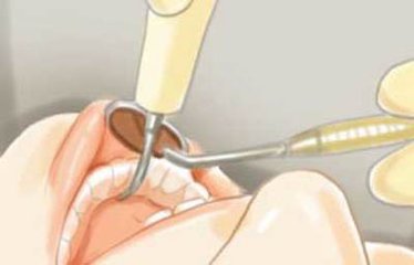洛阳镶牙过程及步骤？