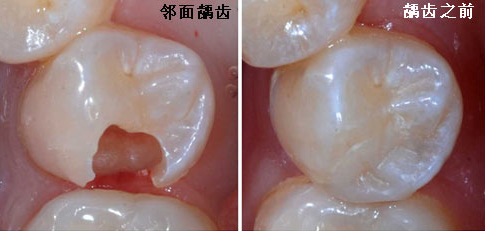 洛阳哪家医院补牙不疼