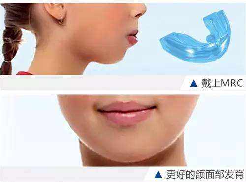 儿童牙齿矫正多少钱？