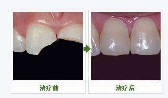 牙齿断了怎么办