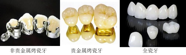 全瓷牙和烤瓷牙的差别