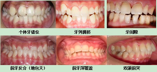 牙齿不齐怎么矫正