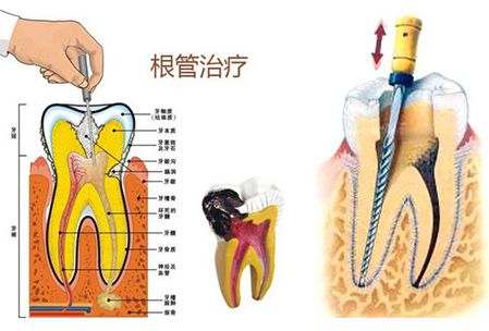 根管治疗疼不疼