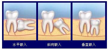 拔牙要多少钱