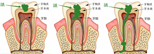 补牙后一定要做牙套吗 
