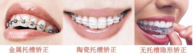 牙齿矫正费用