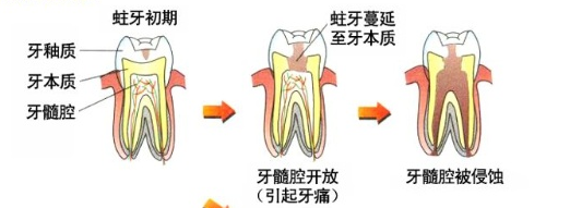 蛀牙疼怎么办