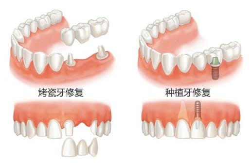 洛阳固定假牙多少钱