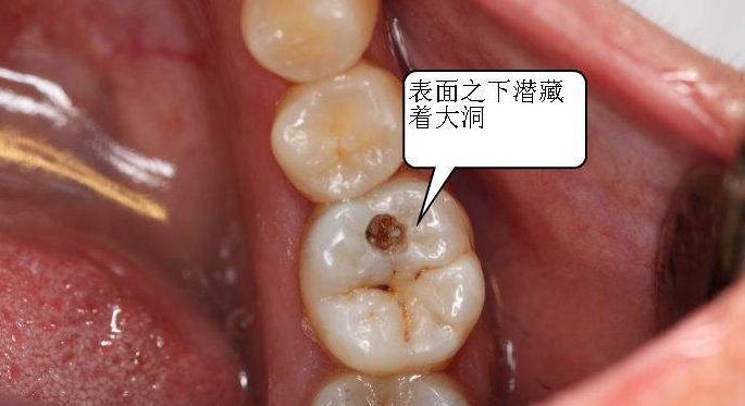 补牙材料掉了怎么办