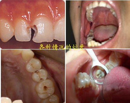 洛阳补牙多少钱