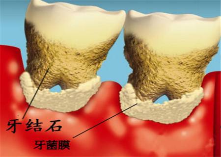 牙结石怎么去除