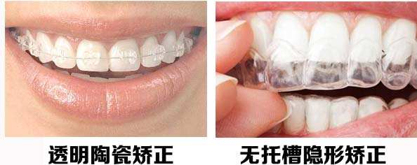 洛阳隐形矫正好不好