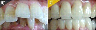 龅牙可以做烤瓷牙吗